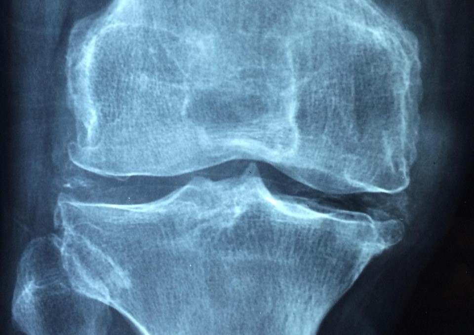 Radiographie d'un genou atteint d'arthrose, montrant la dégradation du cartilage articulaire.